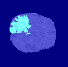 Axial slice of human brain with colored pixel label overlay that indicates regions of normal tissue and tumor tissue